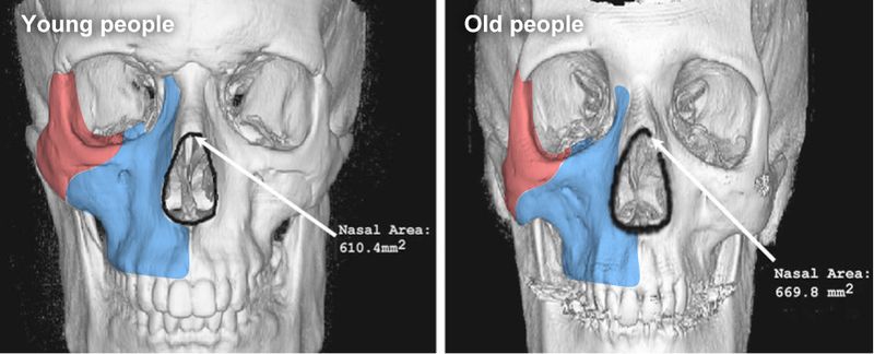 法令紋是因為顴骨和上顎骨體積減少所產生的凹陷