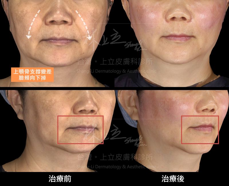 治療中臉部位，針對顴骨和鼻肌底去重建體積支撐，可見人中的立體度變好、嘴形變翹，嘴角木偶紋也有相對改善。