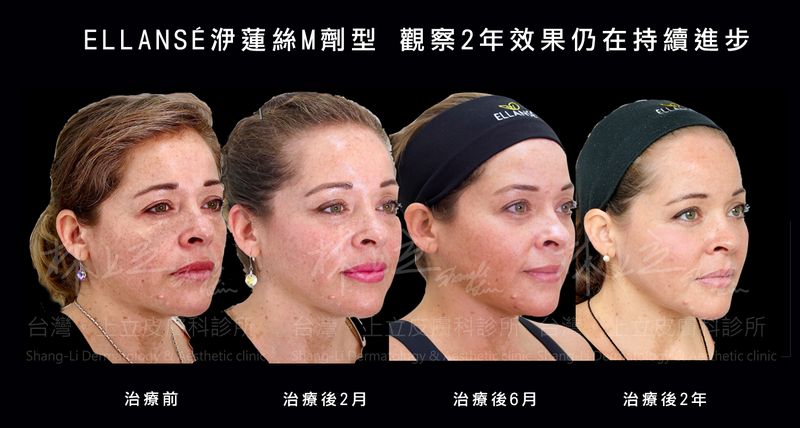 洢蓮絲Ｍ劑型的維持時間更久，治療後2年，可見臉部緊緻拉提效果的仍在不斷進步中。