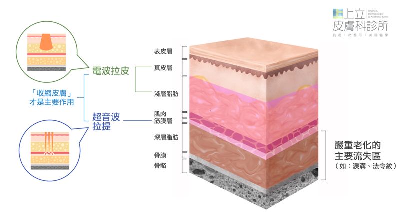 電波拉皮或超音波拉提的主要作用都是收縮肌膚，達到真正的拉提淚溝效果