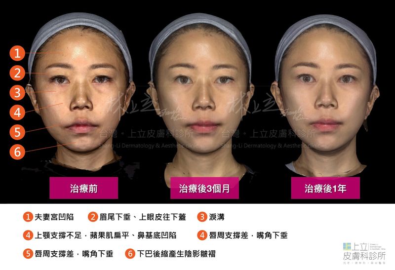 AestheFill艾麗斯治療案例二治療問題