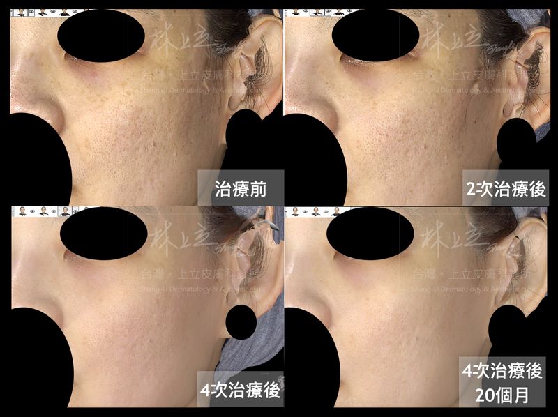 經過2次皮秒雷射的治療之後，皮膚狀況已經進步許多，膚色變亮、毛孔縮小了、痘疤造成的凹凸不平也平滑許多