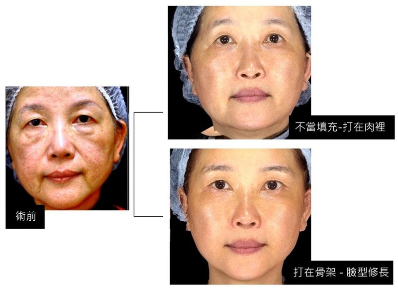 案例經由林上立醫師的補救，將劑量分配於深層的支撐，可明顯看出，不僅紋路的改善更加良好，臉型也變得修長、年輕化。