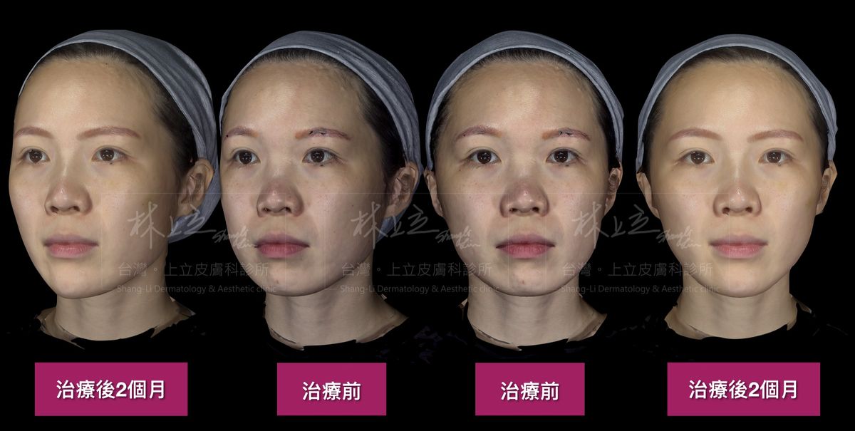 ILIY在利用AestheFill艾麗斯增加中段臉和山根的骨架支撐