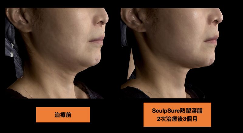 SculpSure熱塑溶脂（絲酷秀）針對下巴脂肪有很好的減脂效果