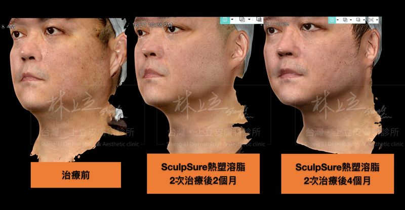 接受２次SculpSure熱塑溶脂（絲酷秀）的治療後，隨著下巴脂肪減少、皮膚變緊實，也為臉部重新找回鮮明的輪廓線條
