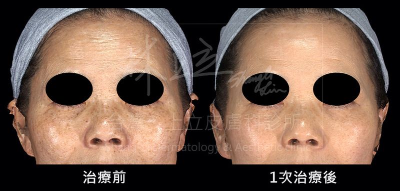 皮秒雷射1次治療後，效果同步改善了臉部的斑點、黯沉、額頭細紋