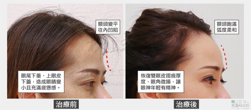 ELLANSÉ洢蓮絲治療前額頭弧度明顯往內凹陷，治療後則恢復到飽滿柔和弧度。