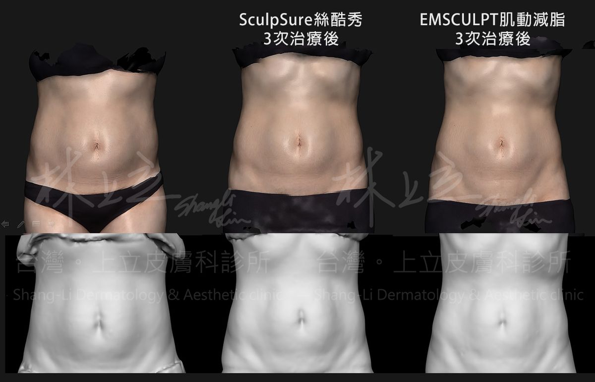 SculpSure熱塑溶脂和EMSCULPT肌動減脂有效減去肚子脂肪又不復胖