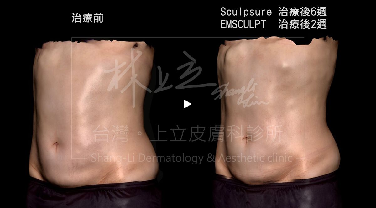 SculpSure熱塑溶脂和EMSCULPT肌動減脂有效減去肚子脂肪又不復胖