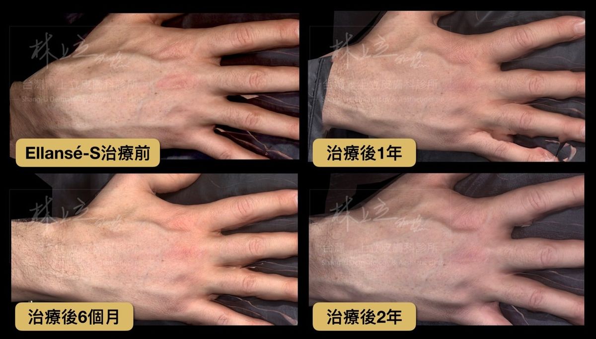 洢蓮絲可以刺激手部肌膚新生膠原蛋白，有效改善雞爪手