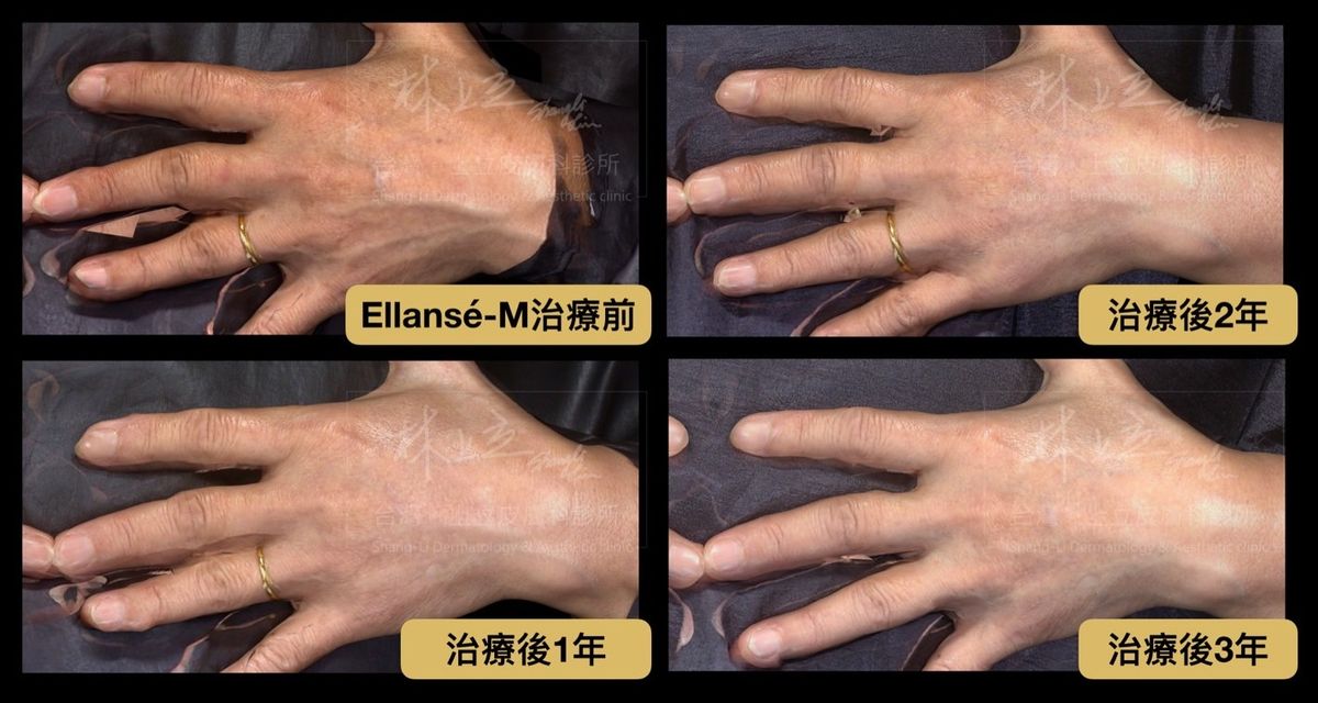 ELLANSÉ洢蓮絲M劑型可以持續刺激皮膚的膠原蛋白，改善雞爪手