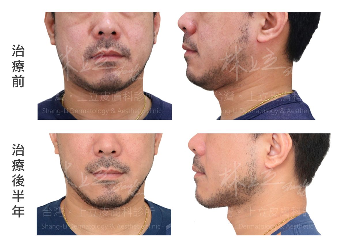 下半臉的雙下巴、下顎線鬆弛也是多男性微整形在意的問題