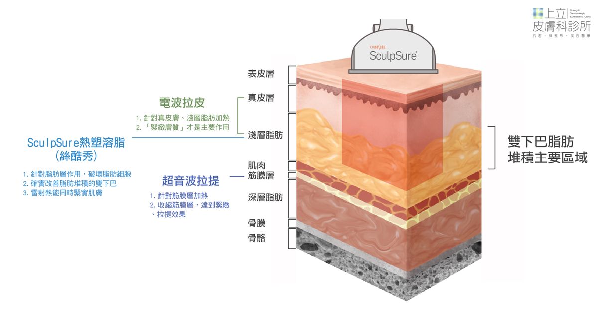 SculpSure熱塑溶脂以非侵入式的方式，透過1060nm雷射波長，精準針對脂肪作用