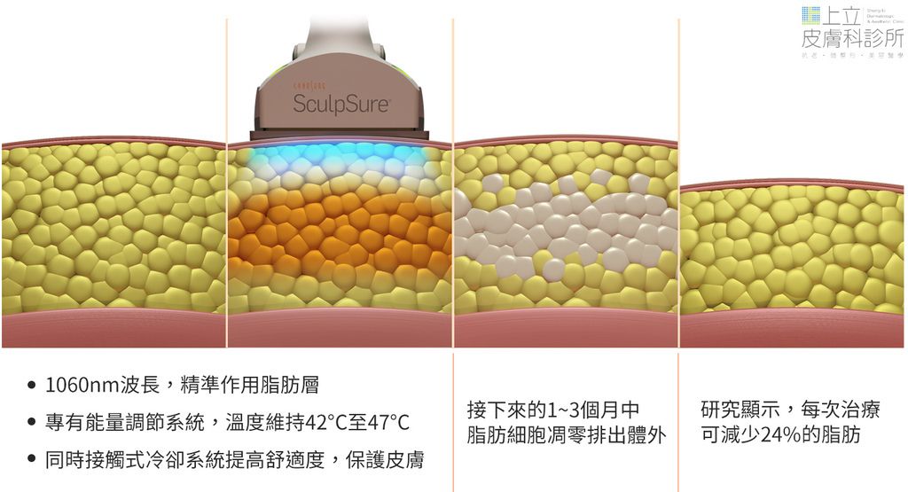 SculpSure熱塑溶脂（絲酷秀體外雷射溶脂），非侵入式作用於體外，運用1060nm雷射波長精準加熱皮下脂肪層