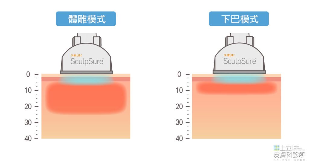 SculpSure熱塑溶脂（絲酷秀體外雷射溶脂）在台灣核准通過下巴減脂的模式。