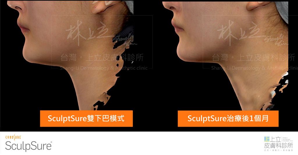 SculpSure熱塑溶脂（絲酷秀體外雷射溶脂）雙下巴治療一個月後的效果