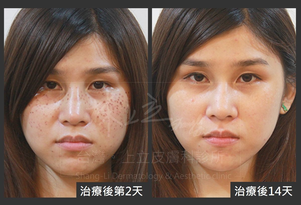 Elena消除了雀斑，整張臉的膚色也變得比較均勻，改善效果相當顯著。