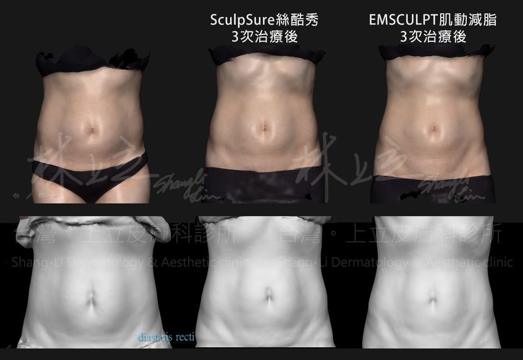 先以SculpSure熱塑溶脂減少腹部脂肪之後，再以EMSCULPT肌動減脂（肌動翹臀）針對肌肉訓練