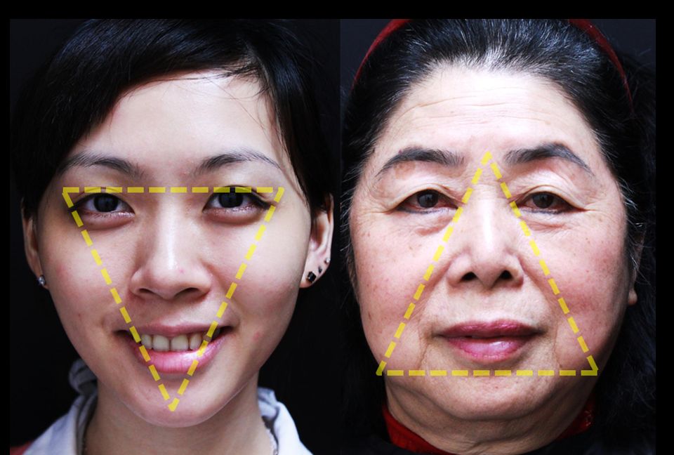 皮膚因老化流失而鬆弛，臉部輪廓也會跟著從緊實的倒三角形，變成鬆弛的正三角形。