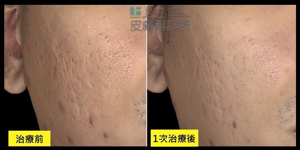 經過一次UP雷射的痘疤治療，仍能觀察到明顯的膚質改善。