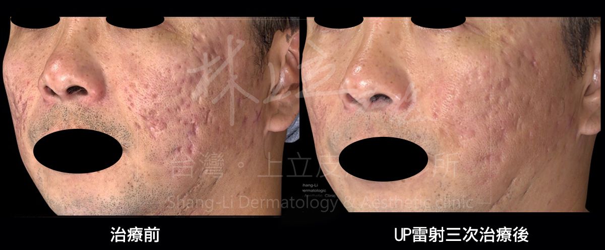 UP雷射3次治療後的成果，可見原先大面積的嚴重痘疤已得到很大幅度的改善。