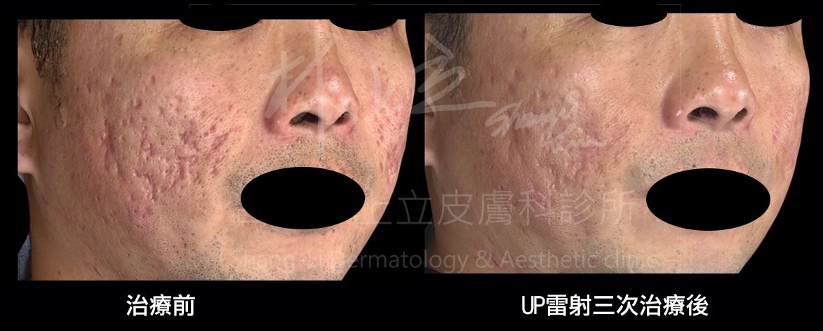 UP雷射在改善凹疤的過程中，你也會發現整體膚質也會變好、更細緻。