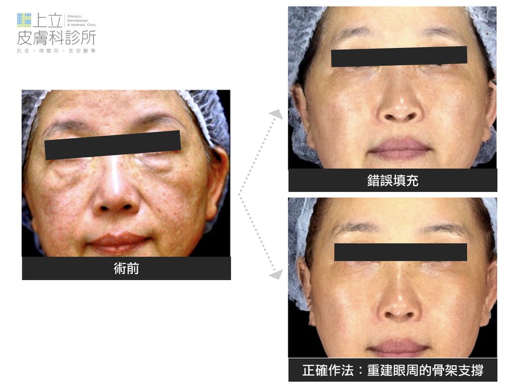 玻尿酸不正確的填補方式，雖然看似臉部皺紋凹陷都填平