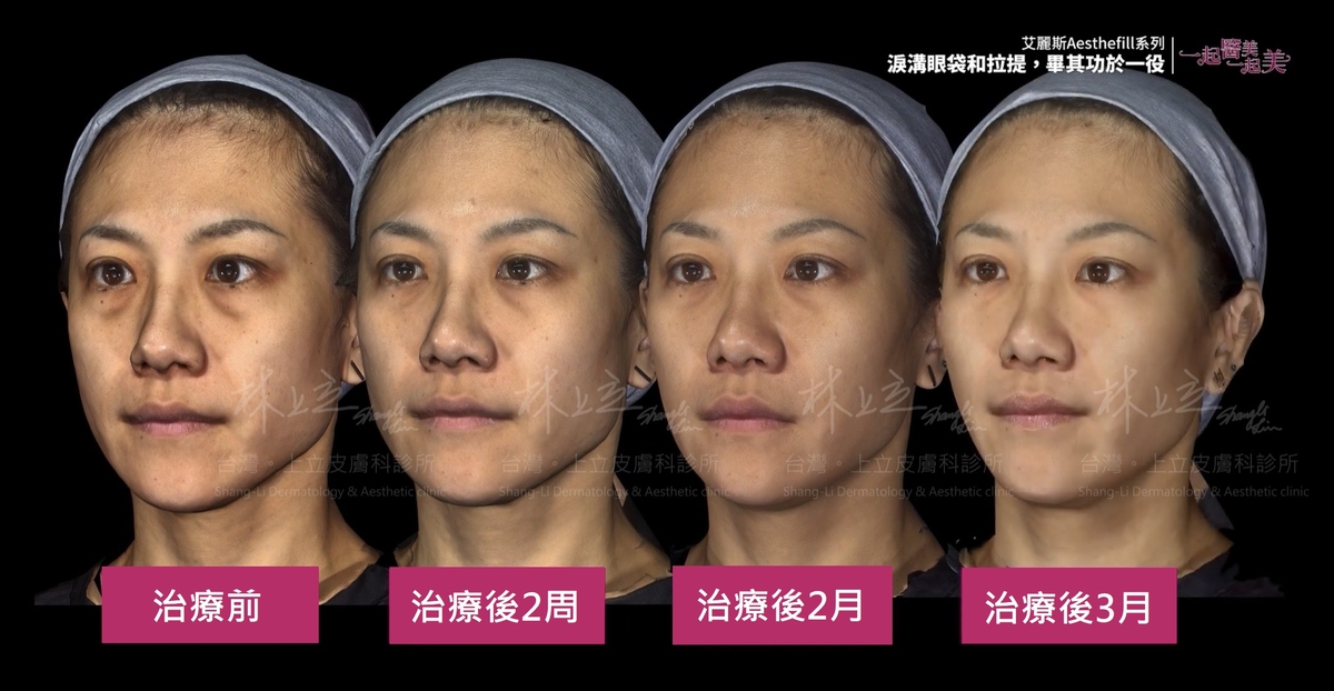 AestheFill艾麗斯在治療後的不同時間段，慢慢改善臉部的老化現象