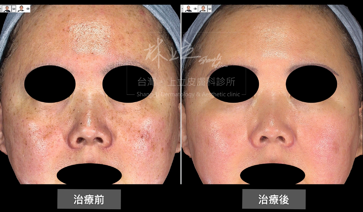 PicoSure755蜂巢皮秒雷射刺激淺層皮膚的膠原蛋白新生，連同眼下細紋和粗大的毛孔都相對改善了。