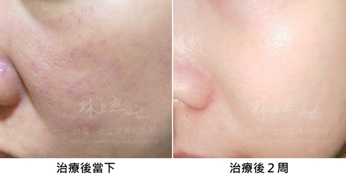 經過1次PicoSure755蜂巢皮秒雷治療後，原本輕微痘疤、毛孔粗大的狀況就得到很不錯的改善效果。