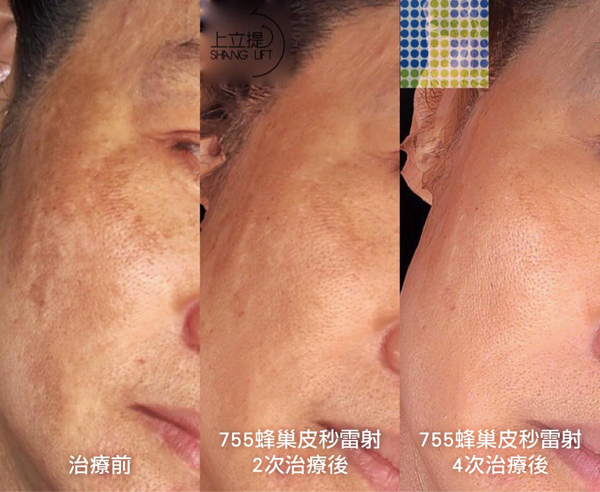 年齡50多歲、膚色黯沉的患者在經過2次PicoSure755蜂巢皮秒雷射治療後，毛孔變得細緻、膚質獲得明顯改善