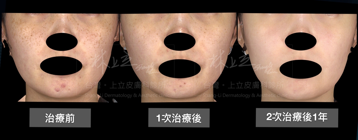 針對臉部大面積的雀斑、膚色黯沉、色素疤等狀況，雖然在PicoSure755蜂巢皮秒雷射的1次治療之後，改善了斑點