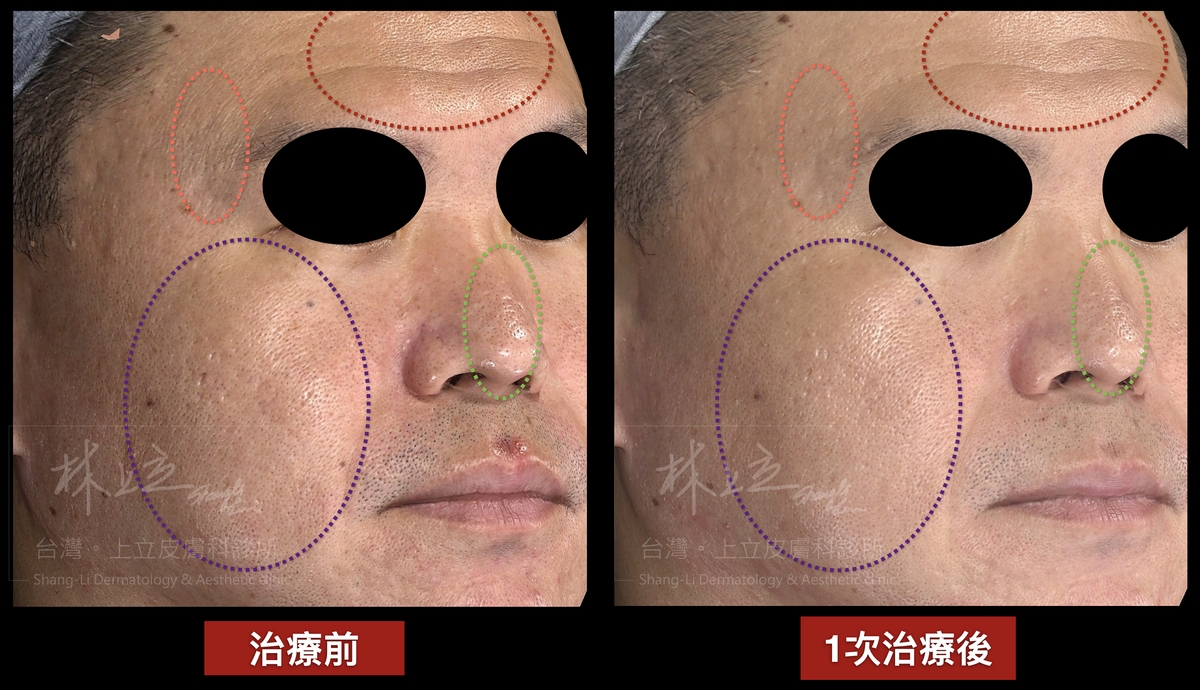 Genius精靈電波２次治療後，不只皮膚的紋路和彈性有所改善，就連痘疤凹疤、粗大毛孔變淺變小許多。