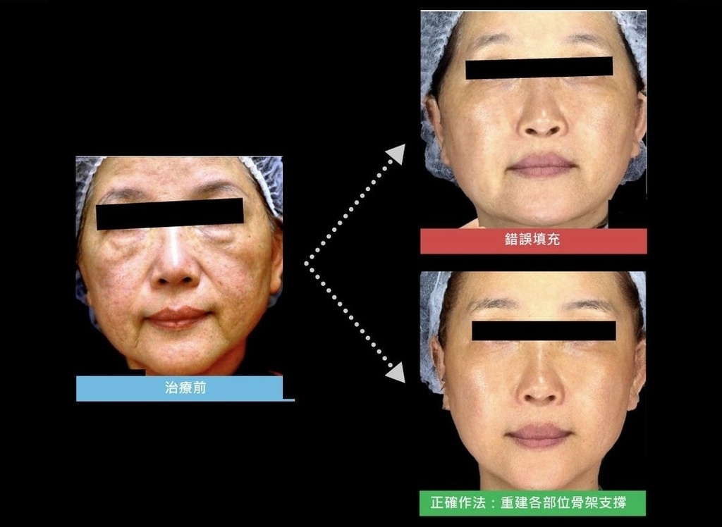 Aesthefill艾麗斯不正確填充，注射材質一昧填補在淺層皮膚，會導致臉部線條臃腫不自然
