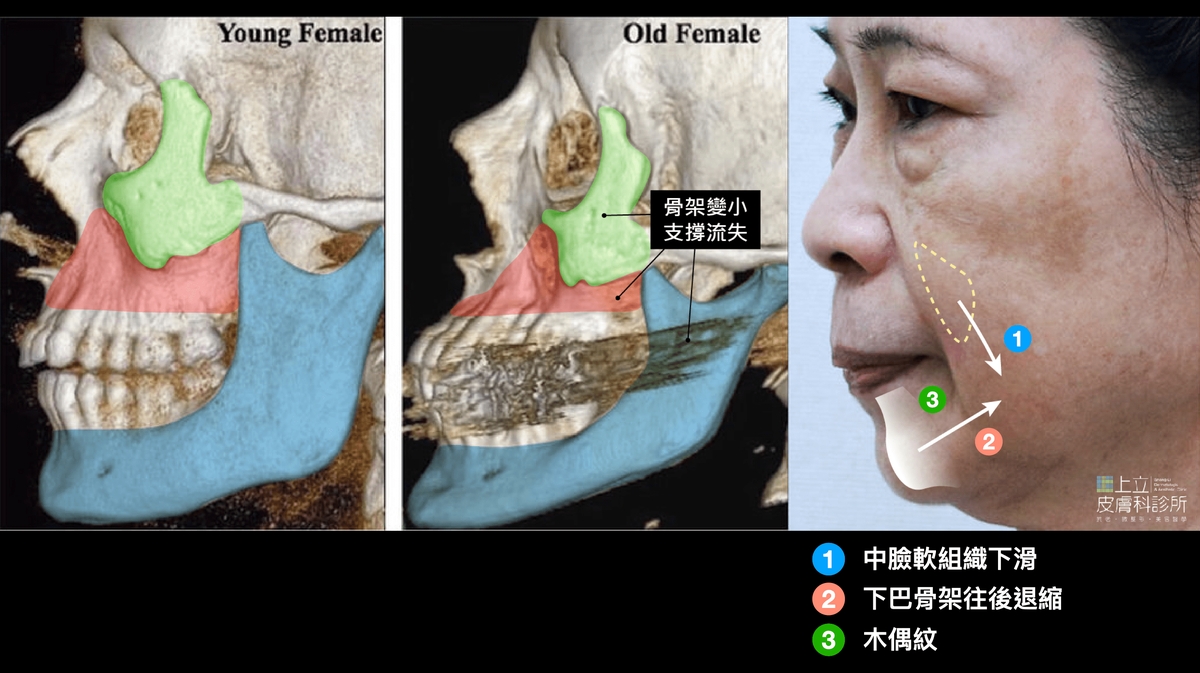 支撐變差了，導致中臉的軟組織下垂和下巴後縮，就在嘴角產生了嘴邊肉和木偶紋。
