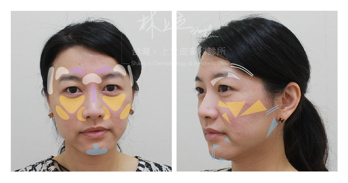 分配注射點位、劑量和深度，才能有效改善臉部的老化紋路和凹陷，同步拉提輪廓