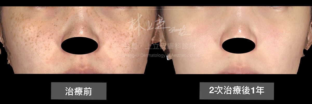 雀斑接受２次PicoSure755蜂巢皮秒雷射治療之後，原本佈滿雙頰的雀斑都被清除乾淨了，就連膚質的細緻度和光澤度都有所進步