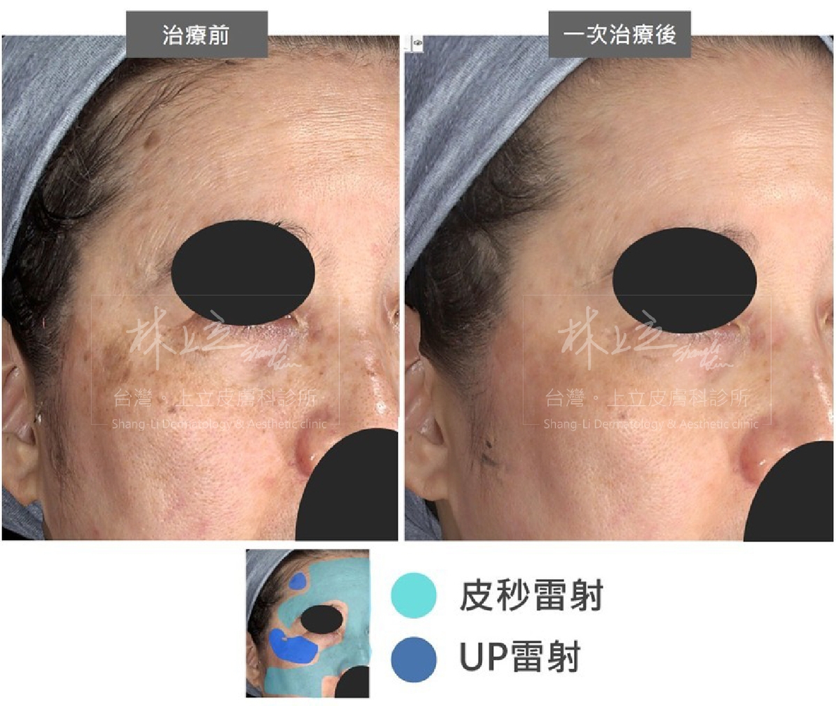 根據臉部的暗沈、斑點、細紋和老人斑劃分出不同區塊，再利用PicoSure755蜂巢皮秒雷射和UP雷射分別進行處理