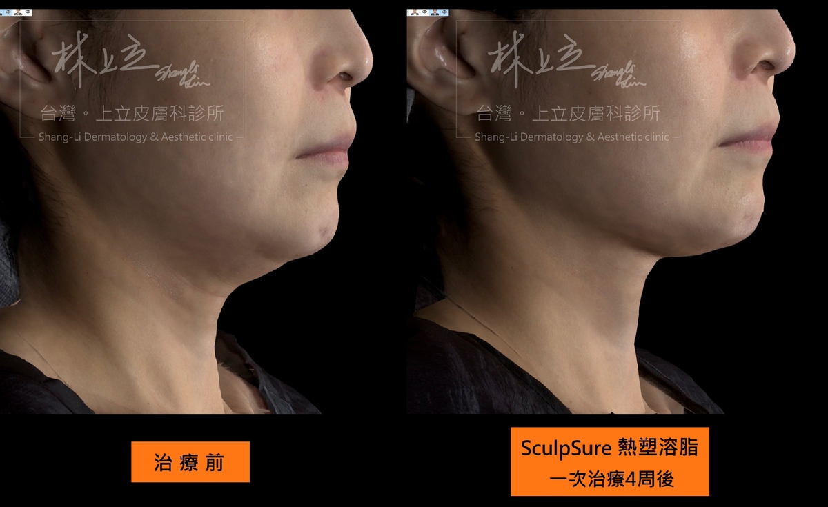 SculpSure熱塑溶脂只要單次治療，就可以明顯減少雙下巴的脂肪
