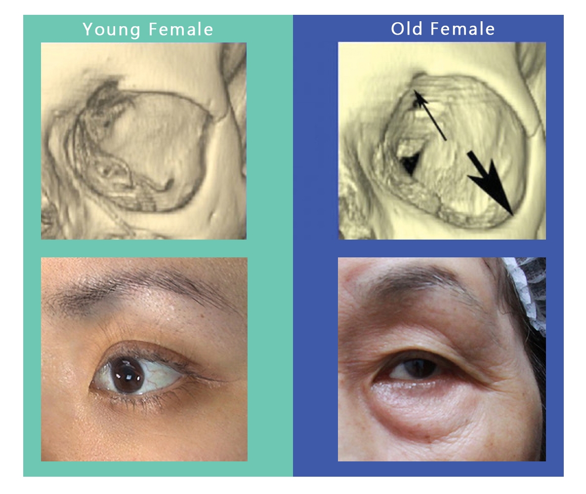 隨著年齡增長、皮膚老化，眼睛周圍的整體老化和眼周骨架流失很有大的關係