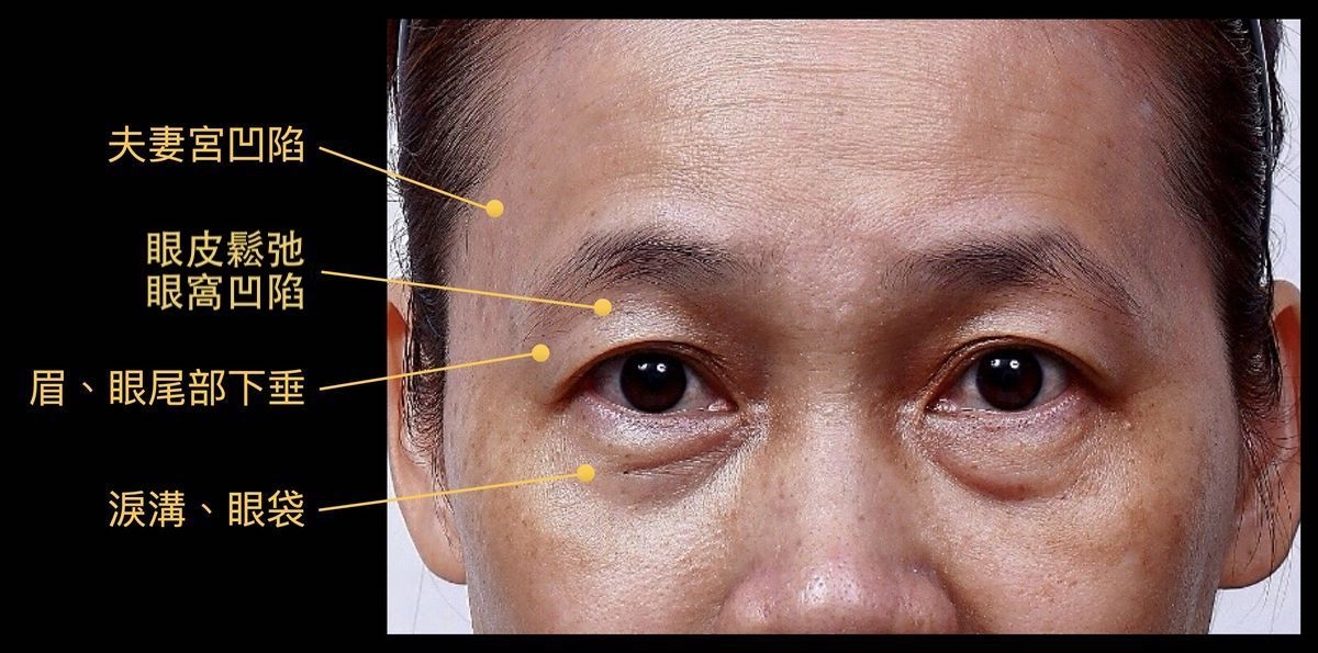 眼周老化症狀大約有４大症狀：淚溝和眼袋、夫妻宮凹陷、眉毛形狀改變