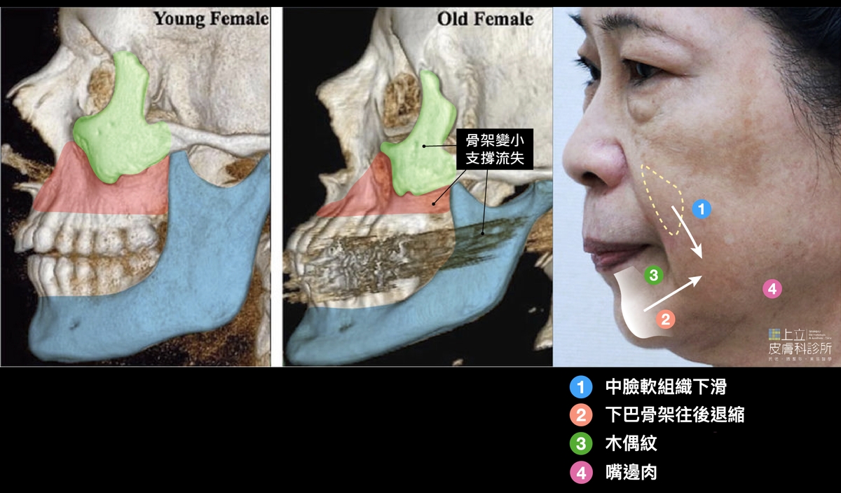 嘴邊肉就是因為中臉骨架流失、臉頰下垂，最終堆積在嘴角外側形成的贅肉。