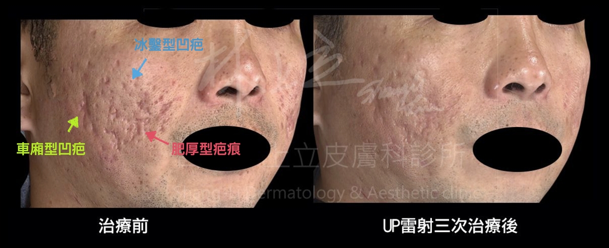 混合了凹疤和凸疤的痘疤型態，UP雷射都能給予有效治療