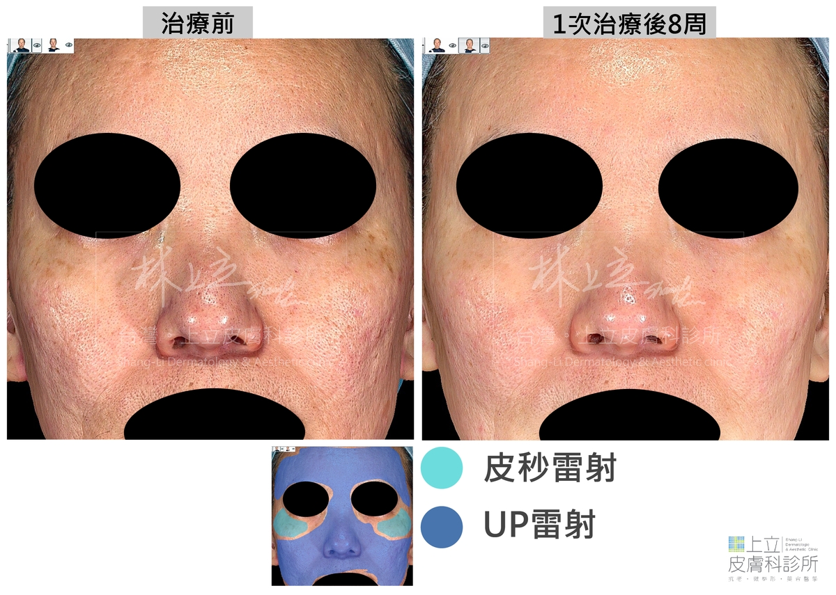 大部分的臉部皮膚使用UP雷射來改善痘疤，再局部施打Picosure755蜂巢皮秒雷射來掃除顴骨母斑