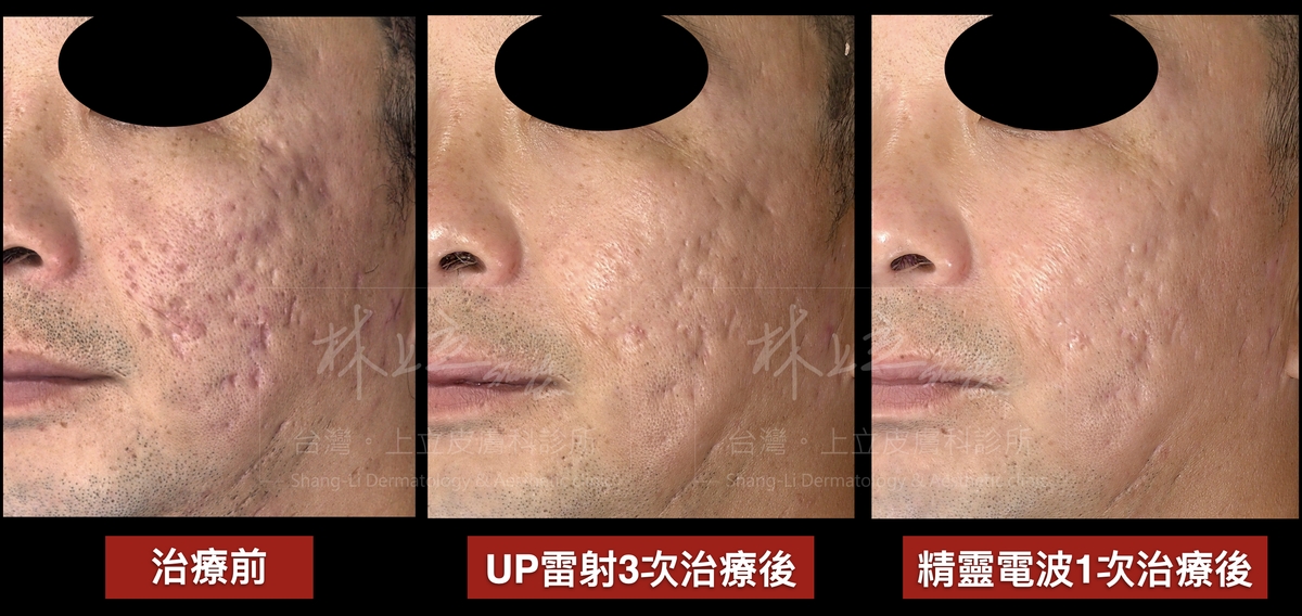 使用UP雷射大幅度改善痘疤的狀況，整體膚況也更細緻、毛孔變小。