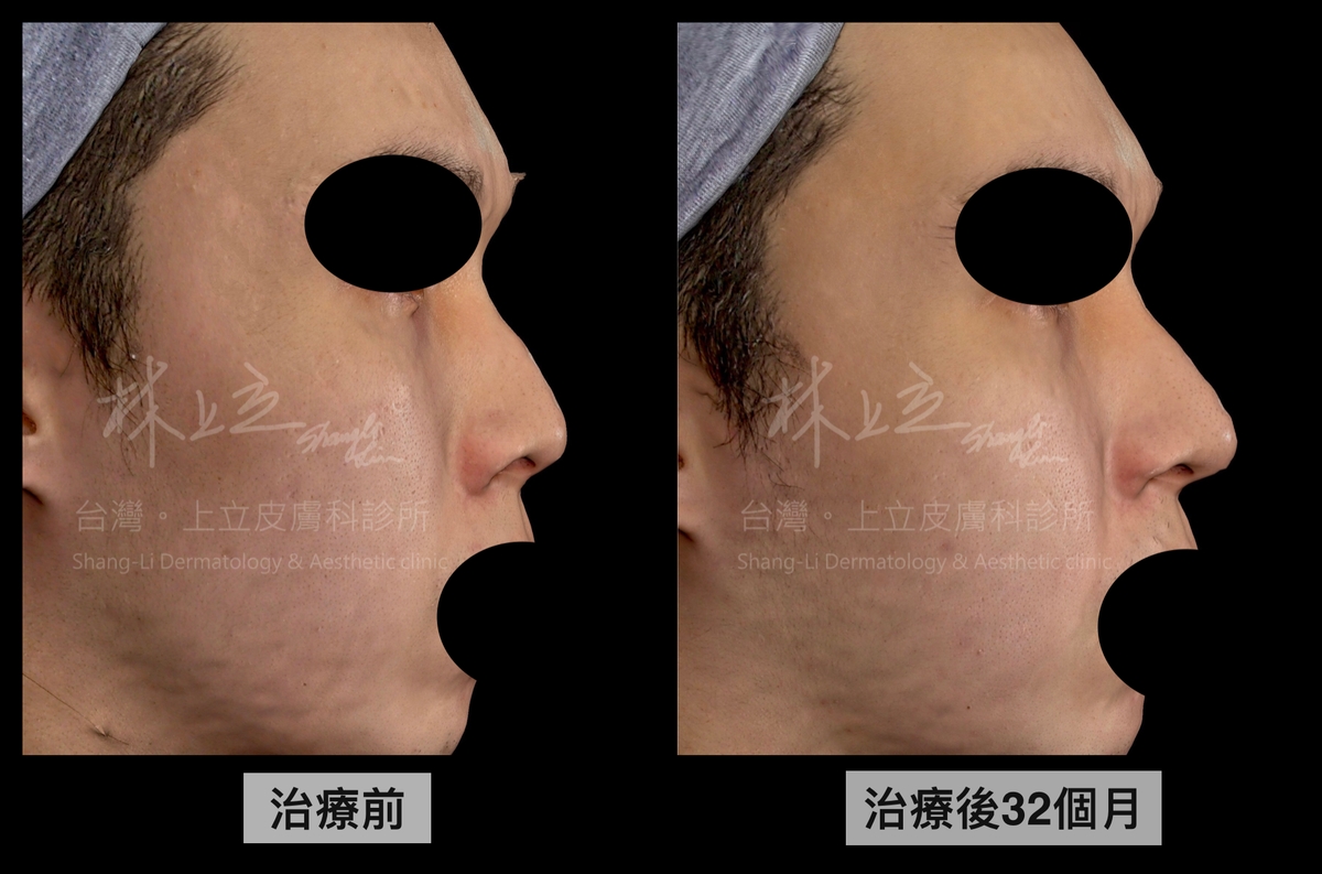 ELLANSÉ洢蓮絲Ｓ劑型使用於鼻型雕塑側面效果照
