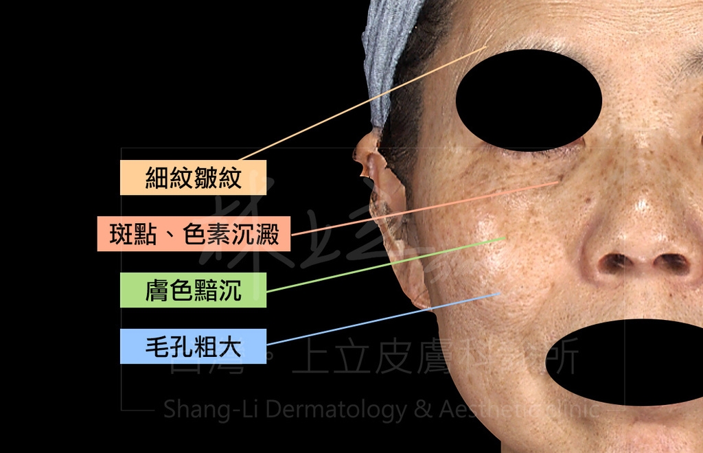 Picosure皮秒雷射治療臉部皮膚斑點問題，解決膚色不均、細紋、毛孔、痘疤等不同面向的狀況。
