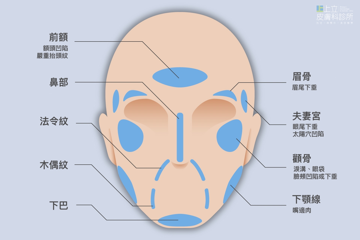 ELLANSÉ洢蓮絲S型可被注射於全臉各個部位，用於改善老化產生的皮膚鬆弛下垂