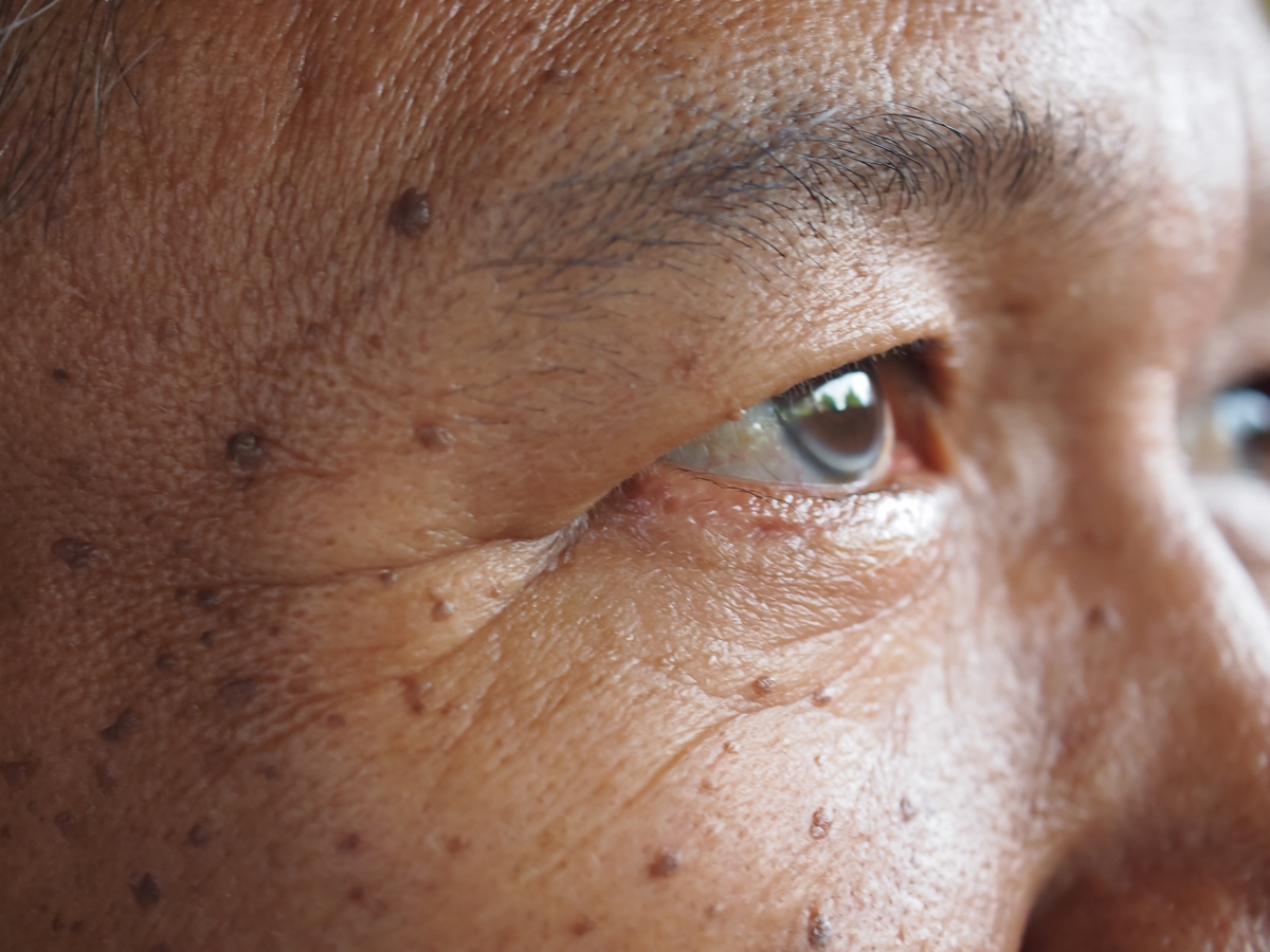 老人斑屬於角質化斑點，會在皮膚表面呈現突起性的色素斑塊